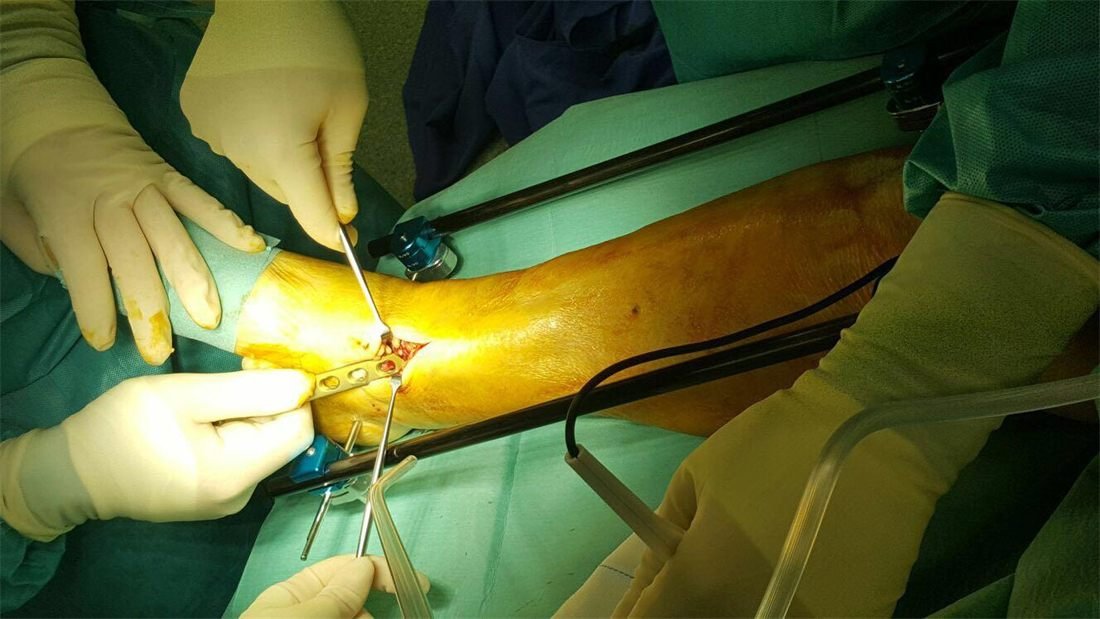 Minimally invasive fracture fixation procedure
